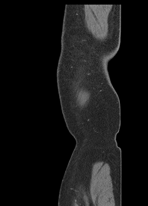 Acute appendicitis (Radiopaedia 48511-53463 Sagittal C+ portal venous phase 129).jpg