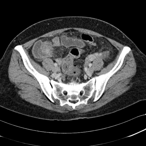 File:Acute appendicitis (Radiopaedia 48792-53822 Axial C+ portal venous phase 89).jpg