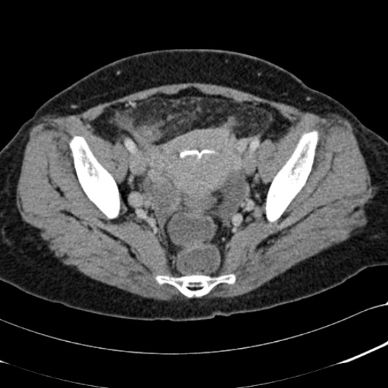 File:Acute appendicitis (Radiopaedia 48792-53822 Axial C+ portal venous phase 99).jpg