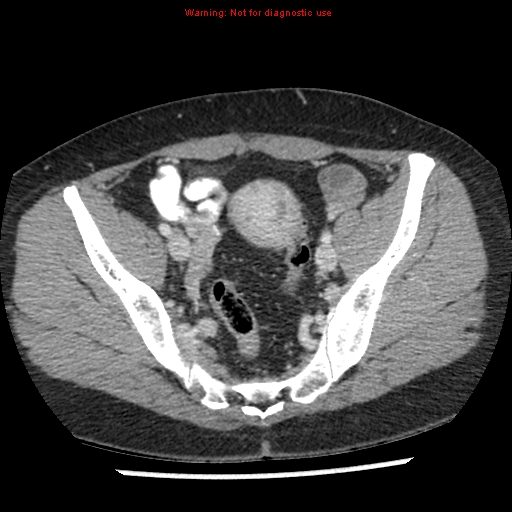 Acute appendicitis (Radiopaedia 7966-8812 C+ portal venous phase 44).jpg