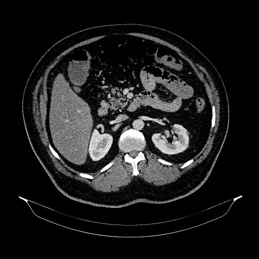 Acute appendicitis (Radiopaedia 79950-93224 Axial C+ portal venous phase 40).jpg