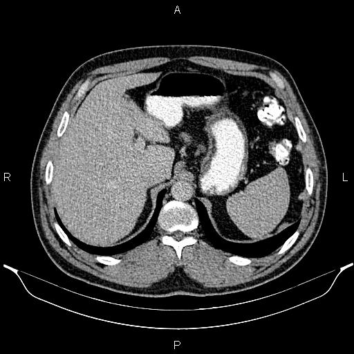 Acute appendicitis (Radiopaedia 84780-100240 Axial C+ portal venous phase 24).jpg