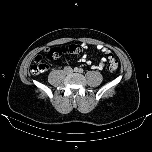Acute appendicitis (Radiopaedia 84780-100240 Axial C+ portal venous phase 70).jpg