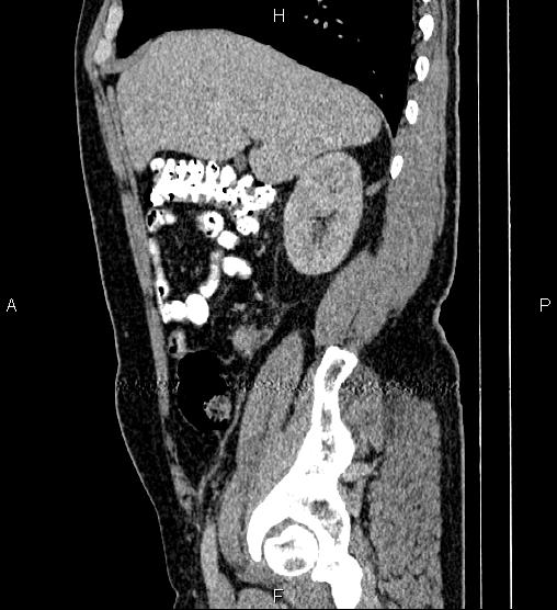 File:Acute appendicitis (Radiopaedia 84780-100240 Sagittal C+ portal venous phase 28).jpg