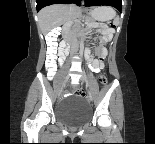 File:Acute appendicitis (Radiopaedia 9417-10099 Coronal C+ portal venous phase 6).jpg