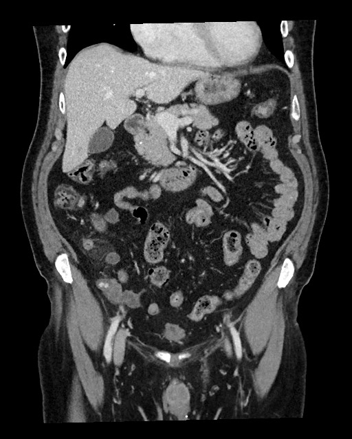 Acute appendicitis - large appendicoliths (Radiopaedia 61805-69820 Coronal C+ portal venous phase 52).jpg