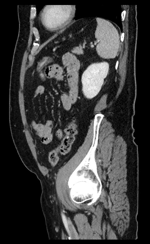 Acute appendicitis - large appendicoliths (Radiopaedia 61805-69820 Sagittal C+ portal venous phase 29).jpg
