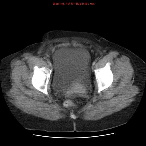 Acute appendicitis complicated by ovarian vein thrombophlebitis (Radiopaedia 16172-15851 Axial C+ portal venous phase 80).jpg