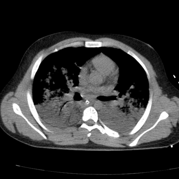 Acute aspiration pneumonitis (Radiopaedia 33605-34703 Axial non-contrast 46).jpg