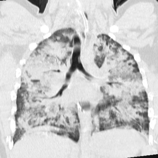 Acute aspiration pneumonitis (Radiopaedia 33605-34703 Coronal lung window 47).jpg