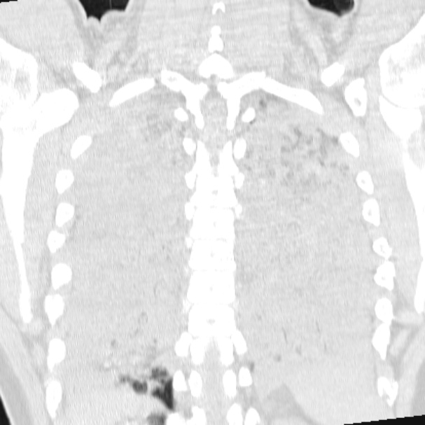 Acute aspiration pneumonitis (Radiopaedia 33605-34703 Coronal lung window 62).jpg