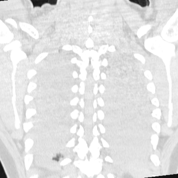 Acute aspiration pneumonitis (Radiopaedia 33605-34703 Coronal lung window 66).jpg