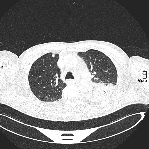 Acute aspiration pneumonitis (Radiopaedia 55642-62166 Axial lung window 58).jpg