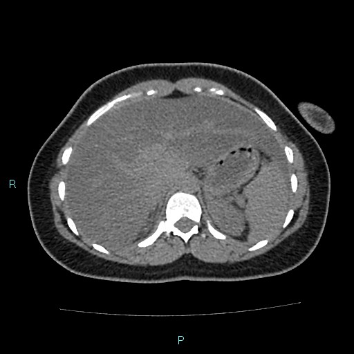 Acute bilateral pyelonephritis (Radiopaedia 37146-38881 Axial non-contrast 25).jpg