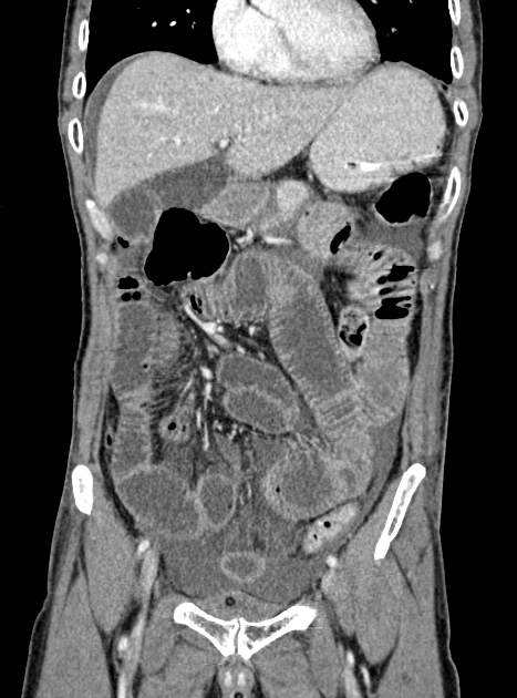 Acute bowel ischemia (Radiopaedia 87695-104114 Coronal C+ portal venous phase 158).jpg