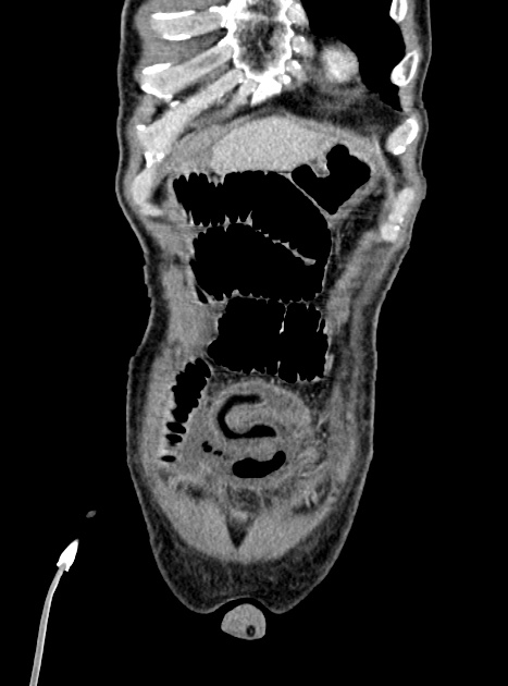 Acute bowel ischemia (Radiopaedia 87695-104114 Coronal C+ portal venous phase 90).jpg