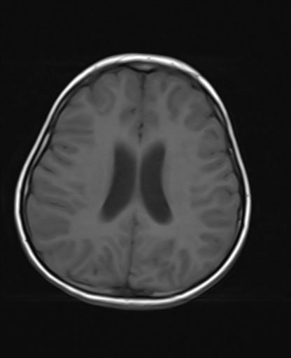 File:Acute cerebellar ataxia (Radiopaedia 61487-69446 Axial T1 15).jpg
