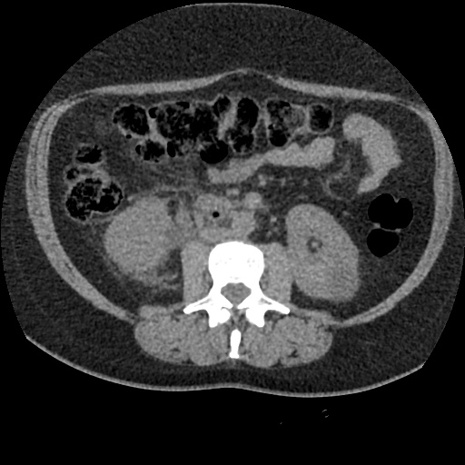 Acute cholecystitis and ureteric colic (Radiopaedia 42330-45444 Axial prone 50).jpg