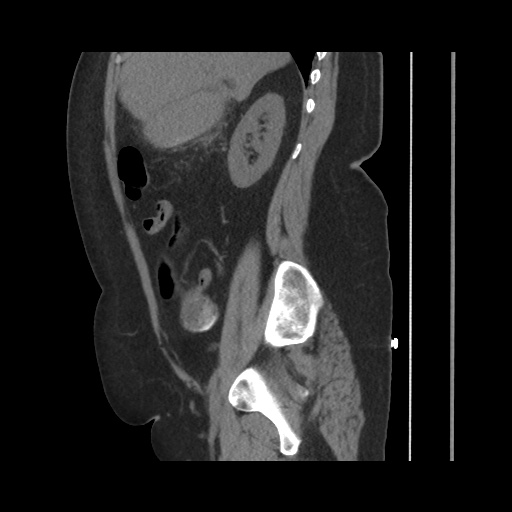 File:Acute cholecystitis with tensile fundus sign (Radiopaedia 71394-81723 Sagittal non-contrast 65).jpg