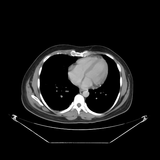 File:Acute complicated calculous cholecystitis (Radiopaedia 55202-61587 Axial C+ delayed 13).jpg