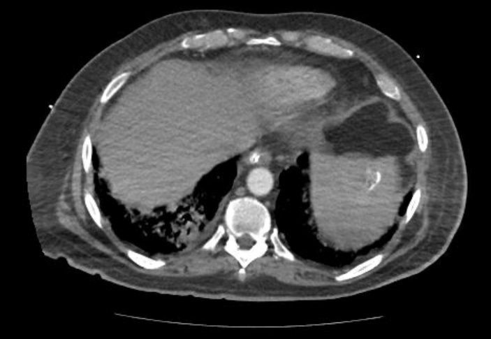 File:Acute cor pulmonale (ultrasound) (Radiopaedia 83508-98818 Axial 137).jpg