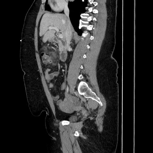 Acute diverticulitis - transverse colon (Radiopaedia 87063-103327 Sagittal C+ portal venous phase 106).jpg