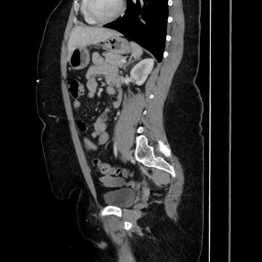 Acute diverticulitis - transverse colon (Radiopaedia 87063-103327 Sagittal C+ portal venous phase 142).jpg