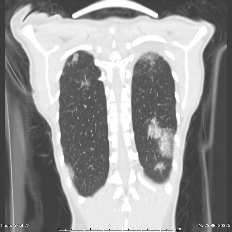 Acute eosinophilic pneumonia (Radiopaedia 48211-53073 Coronal lung window 46).jpg