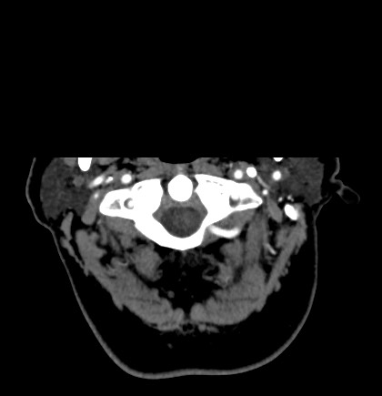 File:Acute internal carotid artery dissection (Radiopaedia 53541-59630 Axial C+ arterial phase 1).jpg