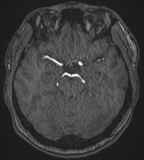 Acute left middle cerebral artery territory infarct with clot retrieval (Radiopaedia 47732-52433 Axial MRA 23).png