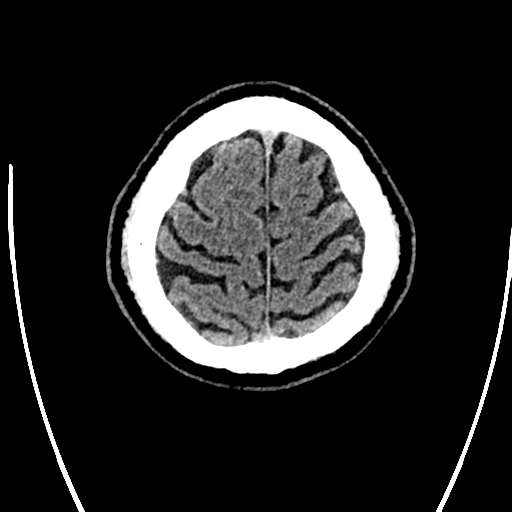 Acute left middle cerebral artery territory ischemic stroke (Radiopaedia 35688-37223 Axial non-contrast 75).png