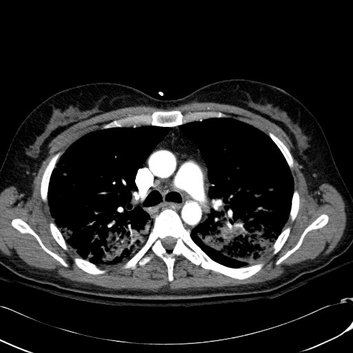 Acute myocardial infarction in CT (Radiopaedia 39947-42415 Axial C+ arterial phase 50).jpg