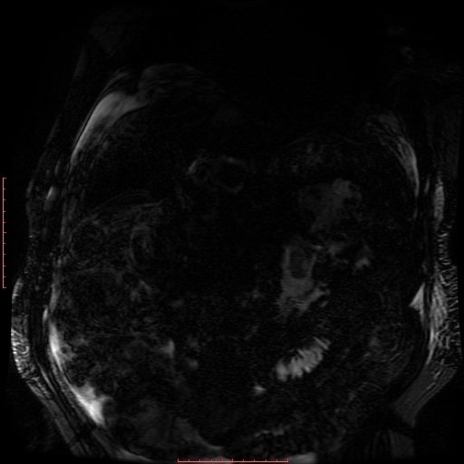 File:Acute necrotizing pancreatitis (Radiopaedia 28194-28448 Coronal MRCP 59).jpg