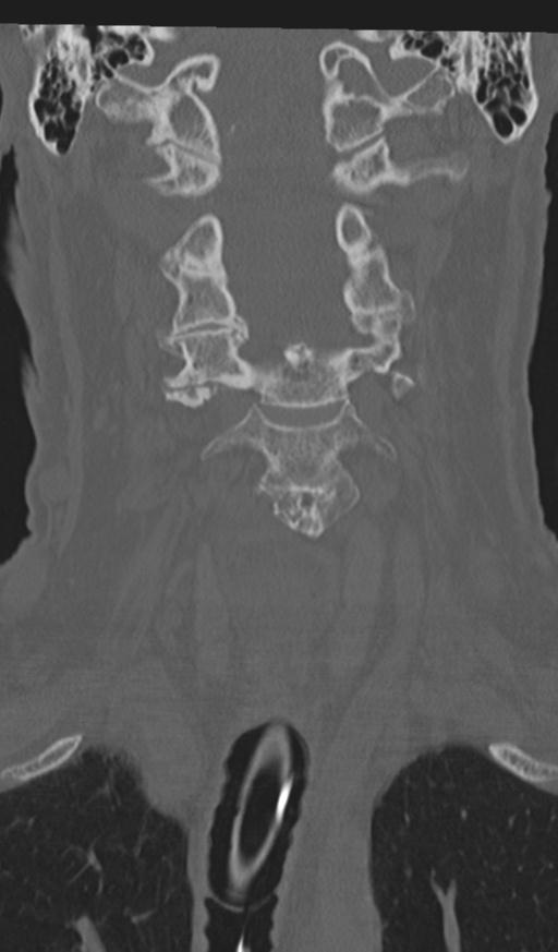 Acute on chronic subdural hematoma and thoracic vertebral injury in a multitrauma patient (Radiopaedia 31698-32619 Coronal bone window 21).jpg