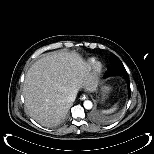 Acute pancreatic necrosis (Radiopaedia 13560-18500 Axial C+ portal venous phase 26).jpg