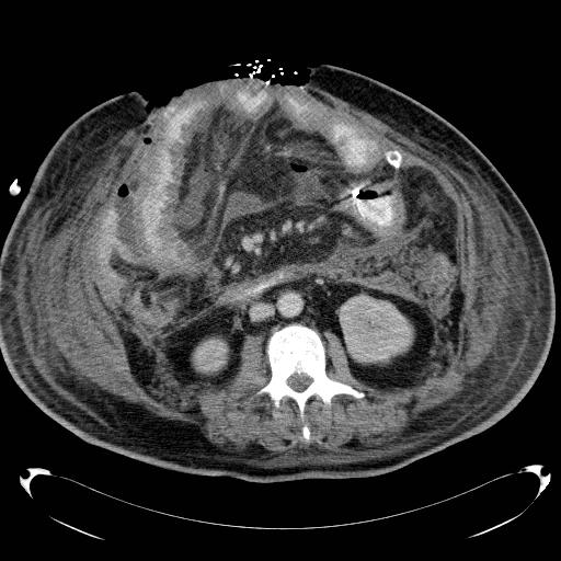 Acute pancreatic necrosis (Radiopaedia 13560-18503 Axial C+ portal venous phase 41).jpg