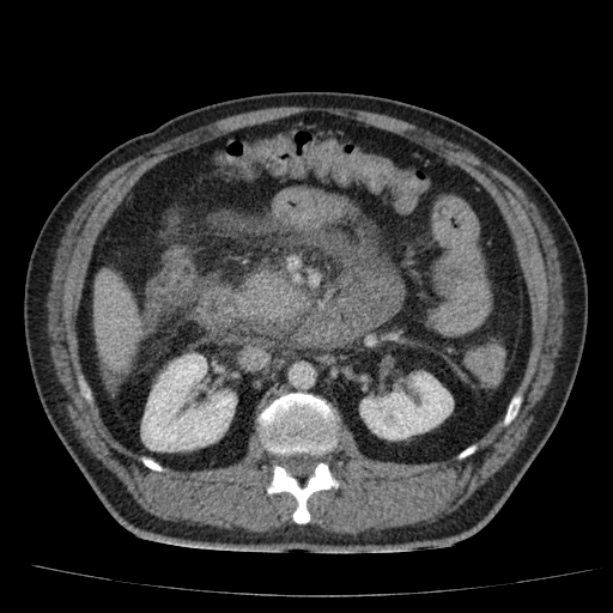 Acute pancreatitis (Radiopaedia 26663-26813 Axial C+ portal venous phase 37).jpg