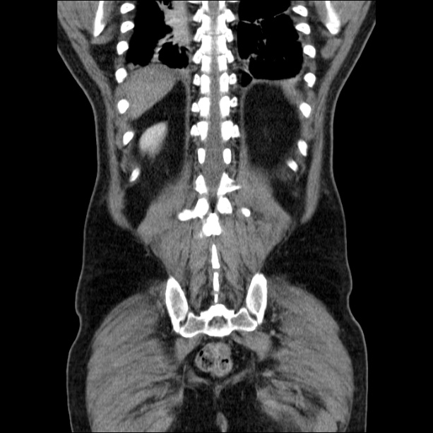 Acute pancreatitis (Radiopaedia 26663-26813 Coronal C+ portal venous phase 52).jpg