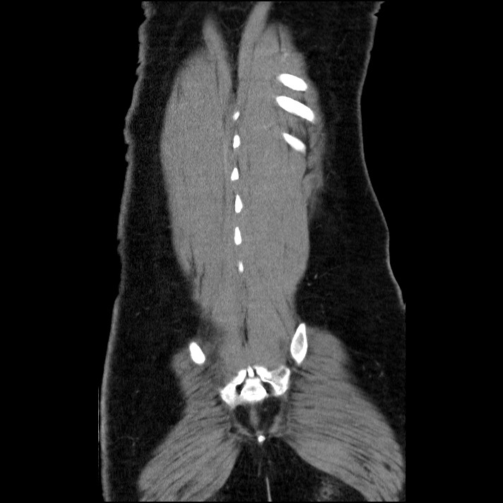 Acute pancreatitis (Radiopaedia 69236-79012 Coronal C+ portal venous phase 17).jpg