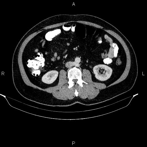Acute pancreatitis (Radiopaedia 85390-101010 Axial C+ portal venous phase 56).jpg