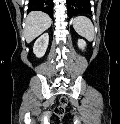 Acute pancreatitis (Radiopaedia 85390-101010 Coronal C+ portal venous phase 58).jpg
