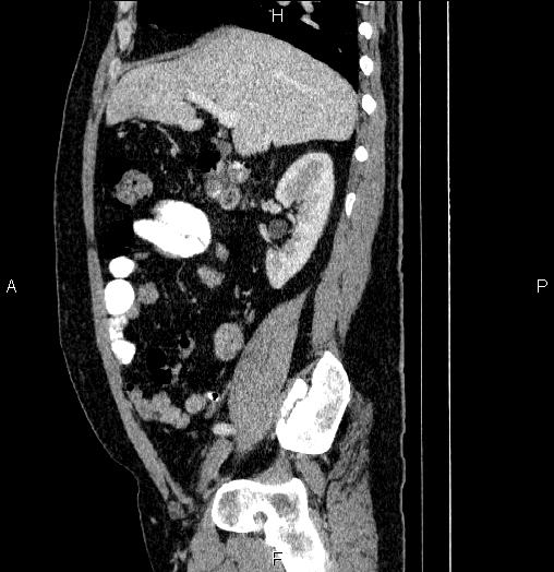 Acute pancreatitis (Radiopaedia 85390-101010 Sagittal C+ portal venous phase 33).jpg