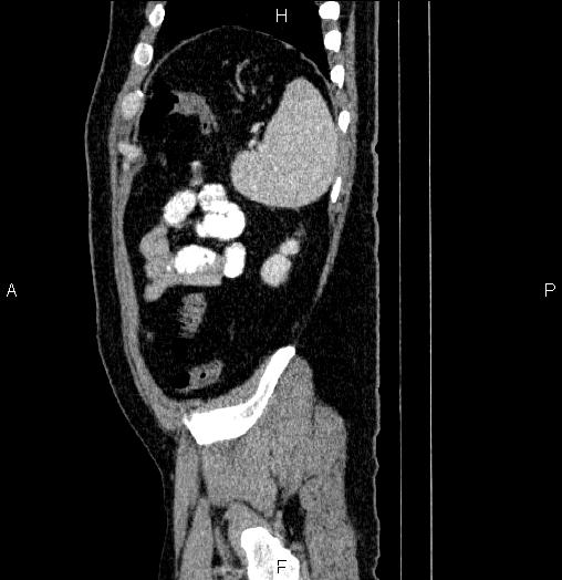 Acute pancreatitis (Radiopaedia 85390-101010 Sagittal C+ portal venous phase 90).jpg