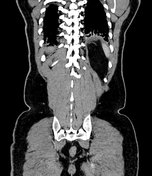 Acute pancreatitis (Radiopaedia 87428-103757 Coronal C+ portal venous phase 79).jpg