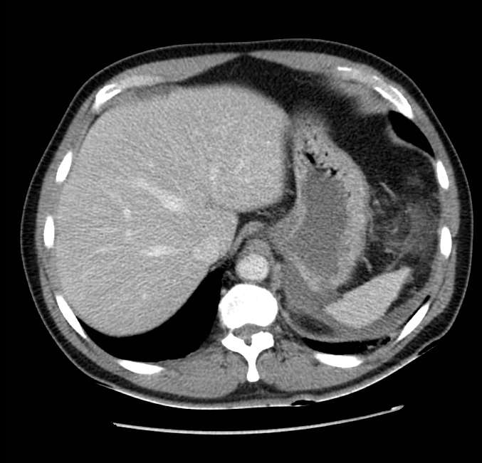 Acute pancreatitis - Balthazar E (Radiopaedia 23080-23110 Axial C+ portal venous phase 12).jpg
