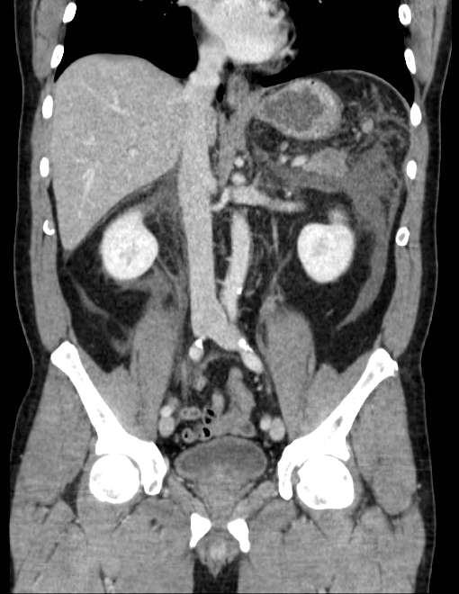 Acute pancreatitis - Balthazar E (Radiopaedia 23080-23110 Coronal C+ portal venous phase 43).jpg