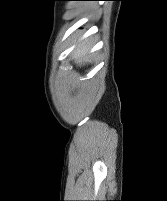 Acute pancreatitis - Balthazar E (Radiopaedia 23080-23110 Sagittal C+ portal venous phase 3).jpg