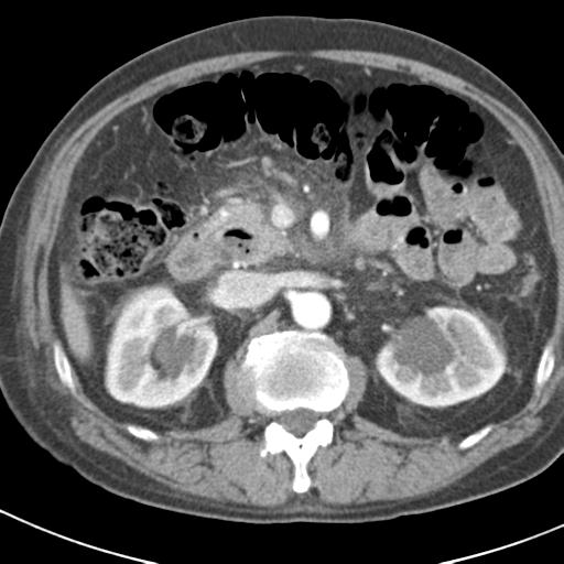 File:Acute pancreatitis and walled-off necrosis (Radiopaedia 29888-30403 Axial C+ portal venous phase 19).jpg