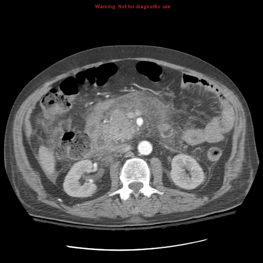 File:Acute pancreatitis with incidental pancreatic lipoma (Radiopaedia 10190-10730 Axial C+ arterial phase 47).jpg