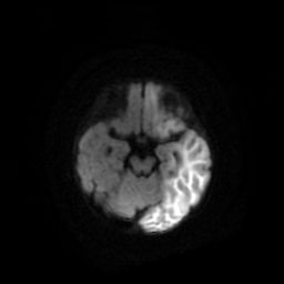 File:Acute phase of hemiconvulsion-hemiplegia epilepsy syndrome (Radiopaedia 29309-29745 Axial DWI 10).jpg